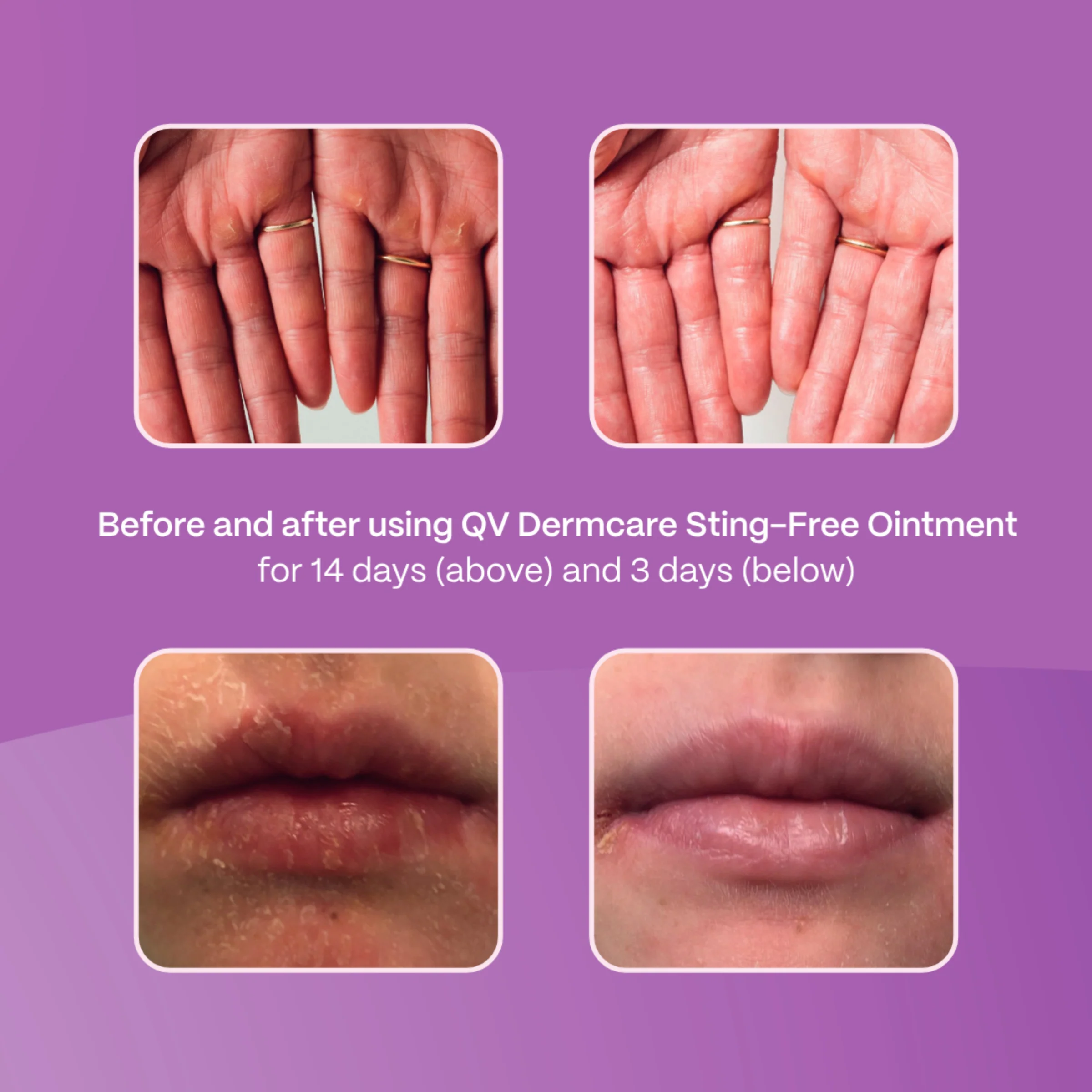 QV Dermcare Sting-Free Ointment - Image 9